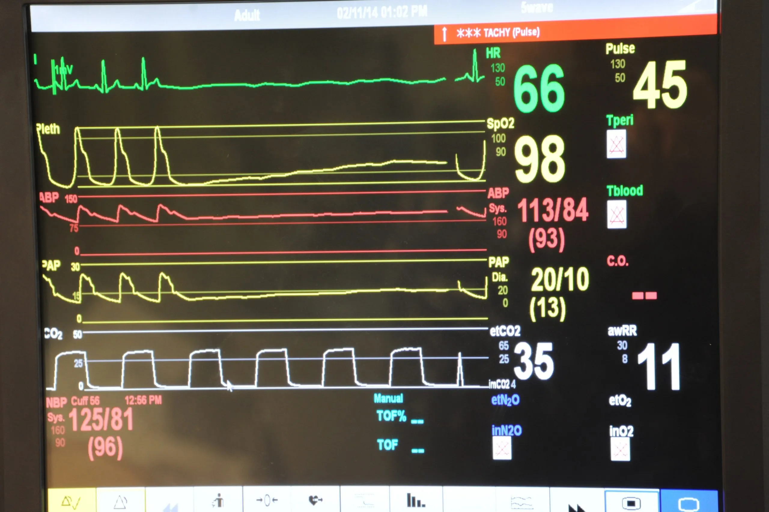 A hospital vital signs monitor display